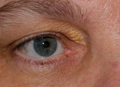 What is the treatment for xanthelasma?