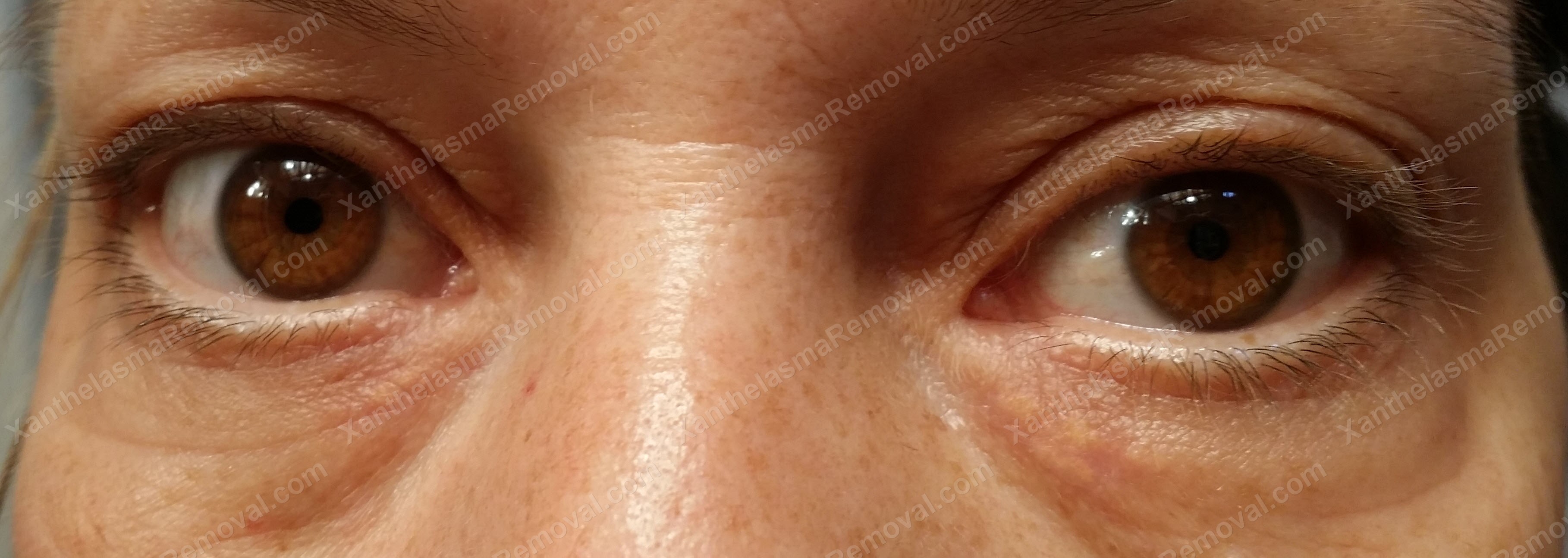 Eyelid+Xanthomas sa: Pigmentation skin xanthomas