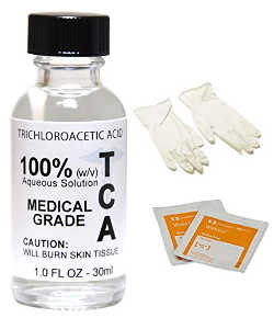 TCA Chemical Peel for xanthelasma