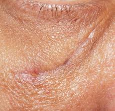 Surgical excisions Xanthelasma